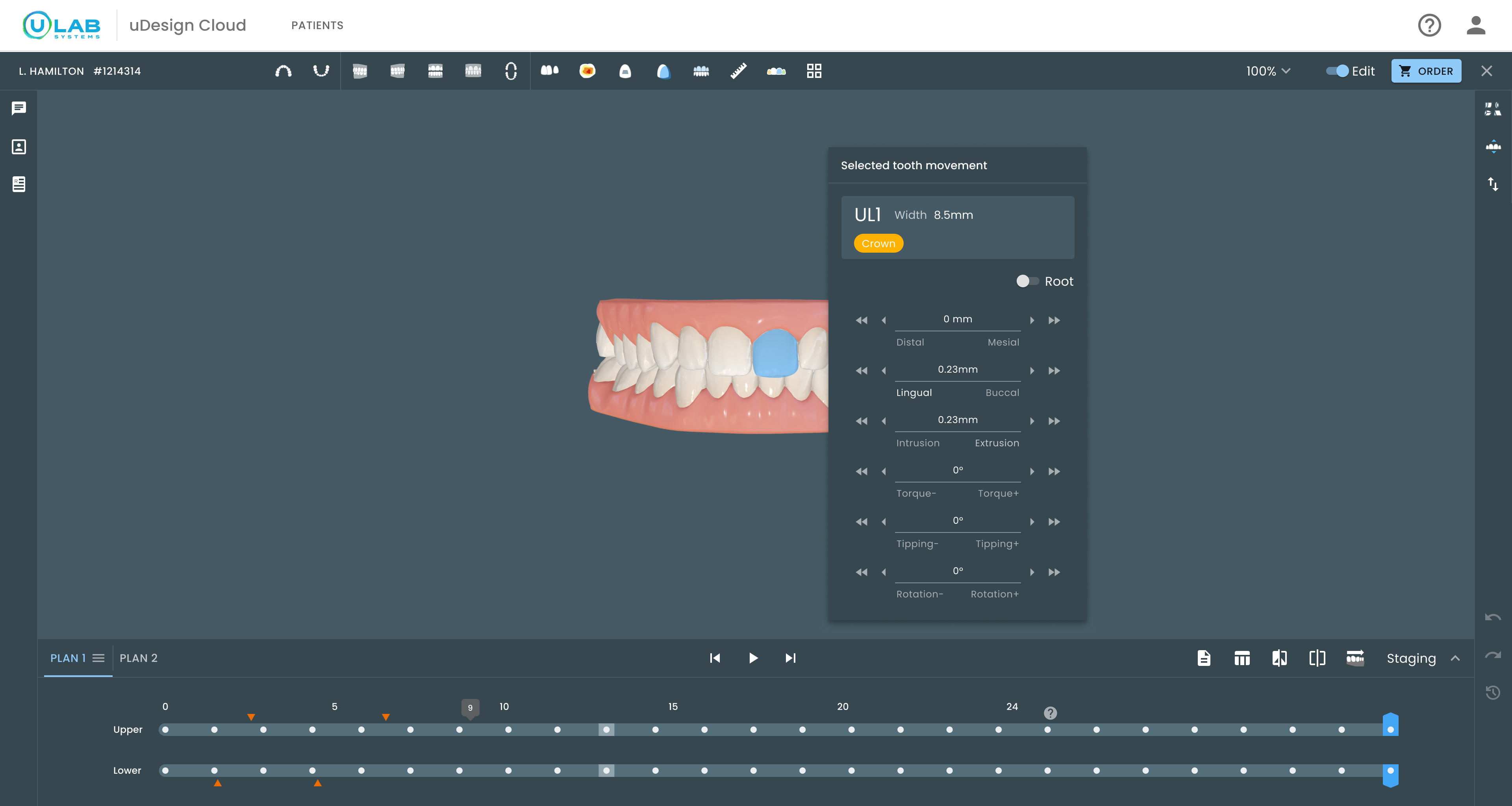 uDesign workspace on a large screen with the Selected tooth movement panel floating beside the selected tooth: every movement axis opens at zero, axes are labeled in prescription vocabulary — Distal/Mesial, Lingual/Buccal, Intrusion/Extrusion, Torque, Tipping, Rotation — in millimeters and degrees, each with coarse and fine steppers, typed entry, and direct drag on the model