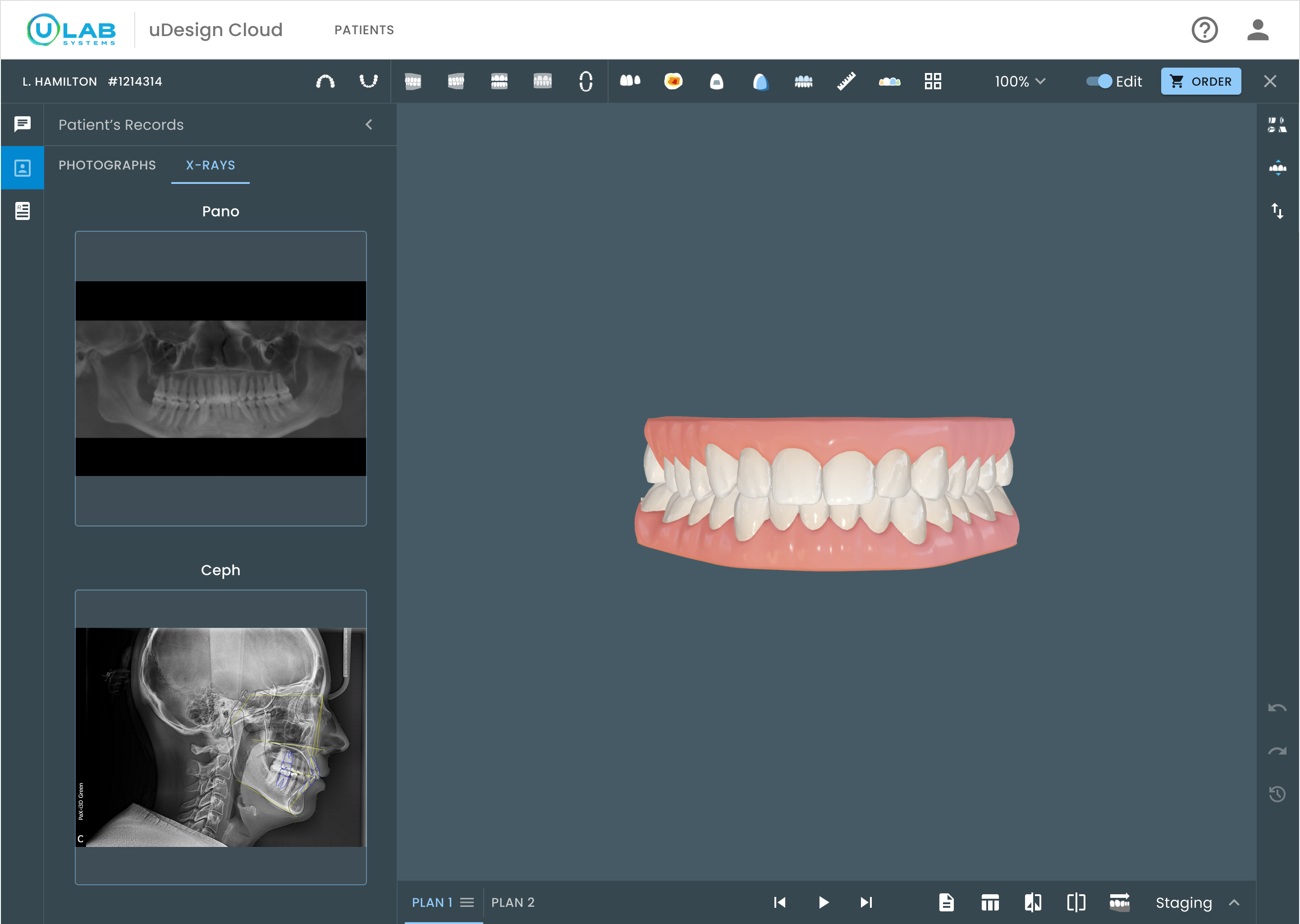 uDesign Cloud workspace with patient X-rays open beside the 3D treatment plan